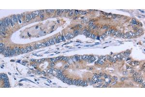 Immunohistochemistry of paraffin-embedded Human colon cancer using SLC1A6 Polyclonal Antibody at dilution of 1:40 (SLC1A6 Antikörper)