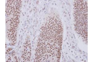 IHC-P Image Immunohistochemical analysis of paraffin-embedded human colon carcinoma, using XAB2, antibody at 1:250 dilution.