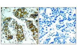 Immunohistochemical analysis of paraffin-embedded human breast carcinoma tissue using cdc25A(Phospho-Ser76) Antibody(left) or the same antibody preincubated with blocking peptide(right). (CDC25A Antikörper  (pSer76))