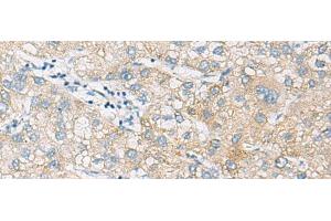 Immunohistochemistry of paraffin-embedded Human liver cancer tissue using NCOA4 Polyclonal Antibody at dilution of 1:130(x200) (NCOA4 Antikörper)