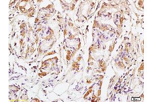 Formalin-fixed and paraffin embedded human colon carcinoma labeled with Anti GM130 Polyclonal Antibody, Unconjugated (ABIN872349) at 1:200 followed by conjugation to the secondary antibody and DAB staining