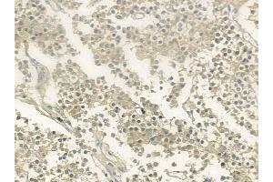 ABIN6260530 and ABIN6273206 at 1/100 staining human pituitary adenoma by IHC-P. (CCDC93 Antikörper  (C-Term))