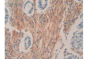 IHC-P analysis of Human Rectum Cancer Tissue, with DAB staining. (CD90 Antikörper  (AA 20-133))