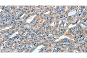 Immunohistochemistry of paraffin-embedded Human thyroid cancer tissue using ANGPT1 Polyclonal Antibody at dilution 1:50 (Angiopoietin 1 Antikörper)