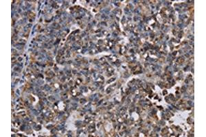 The image on the left is immunohistochemistry of paraffin-embedded Human ovarian cancer tissue using ABIN7130066(LBR Antibody) at dilution 1/50, on the right is treated with fusion protein. (Lamin B Receptor Antikörper)