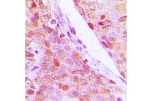 Immunohistochemical analysis of RPL5 staining in human breast cancer formalin fixed paraffin embedded tissue section. (RPL5 Antikörper)