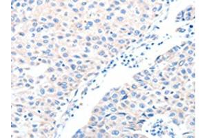 The image on the left is immunohistochemistry of paraffin-embedded Human breast cancer tissue using ABIN7128234(ADAM32 Antibody) at dilution 1/15, on the right is treated with fusion protein. (ADAM32 Antikörper)