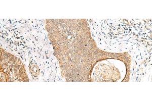 Immunohistochemistry of paraffin-embedded Human esophagus cancer tissue using TOR1A Polyclonal Antibody at dilution of 1:35(x200) (TOR1A Antikörper)
