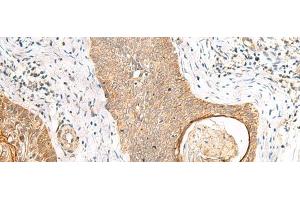 Immunohistochemistry of paraffin-embedded Human esophagus cancer tissue using TOR1A Polyclonal Antibody at dilution of 1:35(x200)