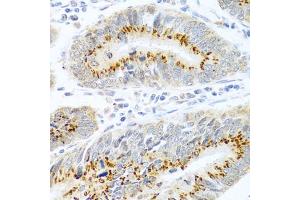 Immunohistochemistry of paraffin-embedded human colon carcinoma using FB antibody (ABIN3021390, ABIN3021391, ABIN3021392 and ABIN6215001) at dilution of 1:100 (40x lens). (FAM3B Antikörper  (AA 30-235))