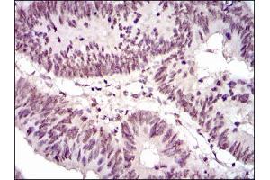 Immunohistochemical analysis of paraffin-embedded rectum cancer tissues using NCK1 mouse mAb with DAB staining. (NCK1 Antikörper)