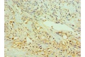 Immunohistochemistry of paraffin-embedded human breast cancer using ABIN7145333 at dilution of 1:100 (TRKB Antikörper  (AA 32-282))