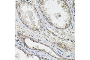 Immunohistochemistry of paraffin-embedded human prostate cancer using UBE2S antibody. (UBE2S Antikörper  (AA 122-221))