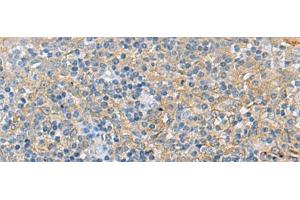 Immunohistochemistry of paraffin-embedded Human tonsil tissue using LRAT Polyclonal Antibody at dilution of 1:55(x200)