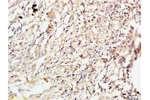 Formalin-fixed and paraffin embedded human lung carcinoma labeled with Anti-ROCK1 Polyclonal Antibody, Unconjugated  at 1:200 followed by conjugation to the secondary antibody and DAB staining. (ROCK1 Antikörper  (AA 1001-1200))