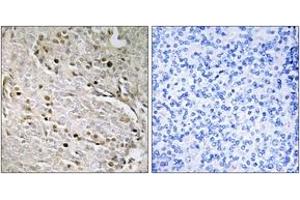 Immunohistochemistry analysis of paraffin-embedded human prostate carcinoma, using POTE8 Antibody.