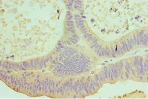 Immunohistochemistry of paraffin-embedded human colon cancer using ABIN7156853 at dilution of 1:100 (IL-22 Antikörper  (AA 34-179))