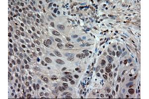 Immunohistochemical staining of paraffin-embedded Adenocarcinoma of colon using anti-NTF3 (ABIN2452683) mouse monoclonal antibody. (Neurotrophin 3 Antikörper  (AA 139-257))