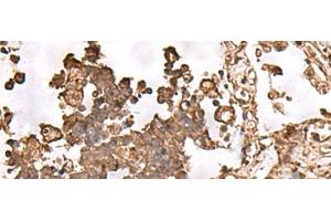 Immunohistochemistry of paraffin-embedded Human lung cancer tissue using FAAP24 Polyclonal Antibody at dilution of 1:30(x200) (FAAP24 Antikörper)