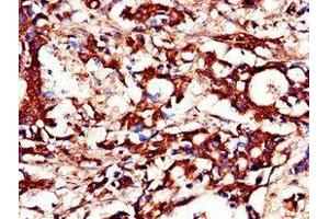 Immunohistochemistry of paraffin-embedded human gastric cancer using ABIN7150756 at dilution of 1:100 (DUSP19 Antikörper  (AA 1-217))