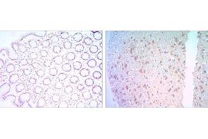 Immunohistochemical analysis of paraffin-embedded colon cancer tissues (left) and human brain tissues (right) using BCL-2 mouse mAb with DAB staining. (Bcl-2 Antikörper)