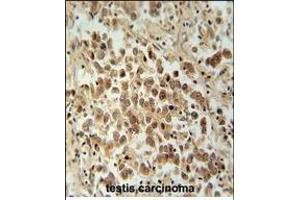 VCX1 Antibody (N-term) (ABIN654781 and ABIN2844462) immunohistochemistry analysis in formalin fixed and paraffin embedded human testis carcinoma followed by peroxidase conjugation of the secondary antibody and DAB staining. (VCX Antikörper  (N-Term))