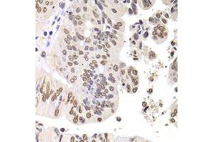 Immunohistochemistry of paraffin-embedded human colon carcinoma using SOX5 antibody.