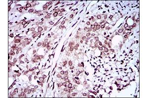 Immunohistochemical analysis of paraffin-embedded cervical cancer tissues using ZEB1 mouse mAb with DAB staining. (ZEB1 Antikörper  (AA 967-1108))