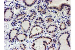 Immunohistochemical staining of paraffin-embedded Carcinoma of Human thyroid tissue using anti-KCNAB1 mouse monoclonal antibody. (KCNAB1 Antikörper)