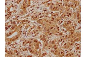 IHC image of ABIN7139904 diluted at 1:100 and staining in paraffin-embedded human liver cancer performed on a Leica BondTM system.