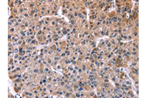 The image on the left is immunohistochemistry of paraffin-embedded Human liver cancer tissue using ABIN7128938(CHRM1 Antibody) at dilution 1/20, on the right is treated with fusion protein. (CHRM1 Antikörper)