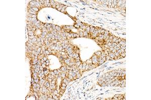 Immunohistochemistry of paraffin-embedded human colon carcinoma using L2 Rabbit pAb (ABIN7265513) at dilution of 1:50 (40x lens). (AFG3L2 Antikörper  (AA 538-797))