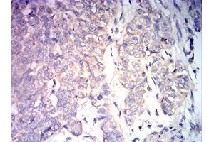 Immunohistochemical analysis of paraffin-embedded bladder cancer tissues using BAX mouse mAb with DAB staining. (BAX Antikörper)