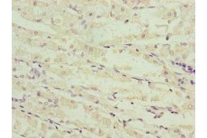 Immunohistochemistry of paraffin-embedded human gastric cancer using ABIN7160967 at dilution of 1:100 (NDUFS6 Antikörper  (AA 29-124))