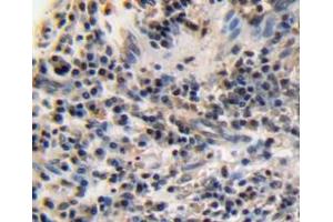 IHC-P analysis of esophagus cancer tissue, with DAB staining. (Ki-67 Antikörper  (AA 3088-3235))
