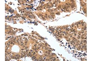 The image on the left is immunohistochemistry of paraffin-embedded Human colon cancer tissue using ABIN7130598(PGC Antibody) at dilution 1/25, on the right is treated with fusion protein. (PGC Antikörper)