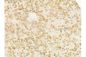 ABIN6264276 and ABIN6279342 at 1/100 staining human hepatocellular carcinoma by IHC-P. (PLA2G4F Antikörper  (C-Term))