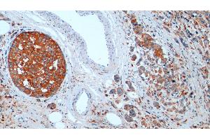 Detection of CTSD in Human Breast cancer Tissue using Monoclonal Antibody to Cathepsin D (CTSD)