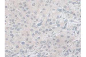 IHC-P analysis of Human Prostate Gland Cancer Tissue, with DAB staining. (PCSK1 Antikörper  (AA 500-738))