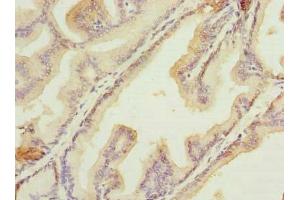 Immunohistochemistry of paraffin-embedded human prostate cancer using ABIN7156012 at dilution of 1:100 (HSDL2 Antikörper  (AA 1-345))