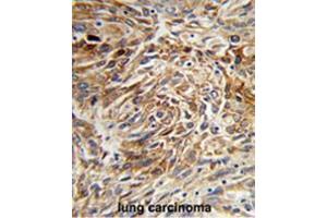 Formalin-fixed and paraffin-embedded human lung carcinoma reacted with AGR3 Antibody (C-term), which was peroxidase-conjugated to the secondary antibody, followed by DAB staining. (AGR3 Antikörper  (C-Term))