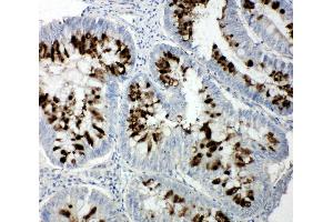 Anti-p107 antibody, IHC(P) IHC(P): Human Intestinal Cancer Tissue (p107 Antikörper  (C-Term))