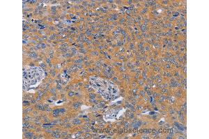 Immunohistochemistry of Human thyroid cancer using BOD1 Polyclonal Antibody at dilution of 1:60