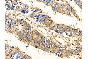 ABIN6261864 and ABIN6266543 at 1/100 staining Human colorectal cancer by IHC-P. (GAD Antikörper  (C-Term))