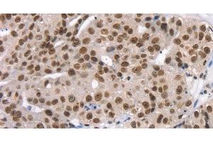 Immunohistochemistry (Paraffin-embedded Sections) (IHC (p)) image for anti-TAF15 RNA Polymerase II, TATA Box Binding Protein (TBP)-Associated Factor, 68kDa (TAF15) antibody (ABIN7239500)