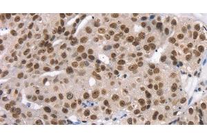 Immunohistochemistry of paraffin-embedded Human breast cancer using TAF15 Polyclonal Antibody at dilution of 1:35 (TAF15 Antikörper)