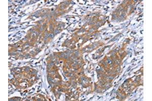 The image on the left is immunohistochemistry of paraffin-embedded Human cervical cancer tissue using ABIN7130635(PITPNM1 Antibody) at dilution 1/40, on the right is treated with fusion protein. (PITPNM1 Antikörper)