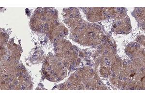 ABIN6272758 at 1/100 staining Human liver cancer tissue by IHC-P. (OR52H1 Antikörper)