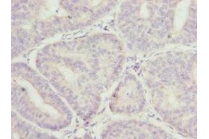 Immunohistochemistry of paraffin-embedded human endometrial cancer using ABIN7158931 at dilution of 1:100