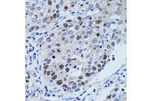 Immunohistochemistry of paraffin-embedded human lung cancer using UHRF1 antibody. (UHRF1 Antikörper)